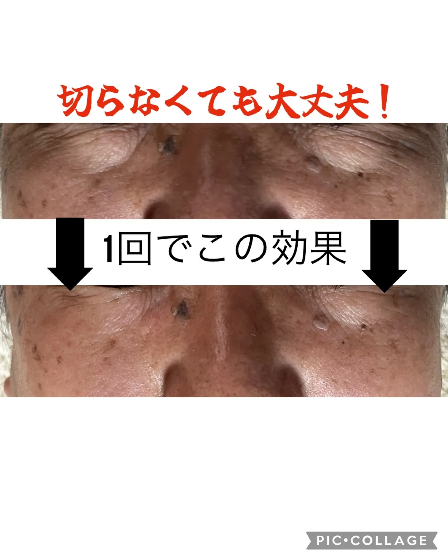 小顔矯正 目袋脂肪解消